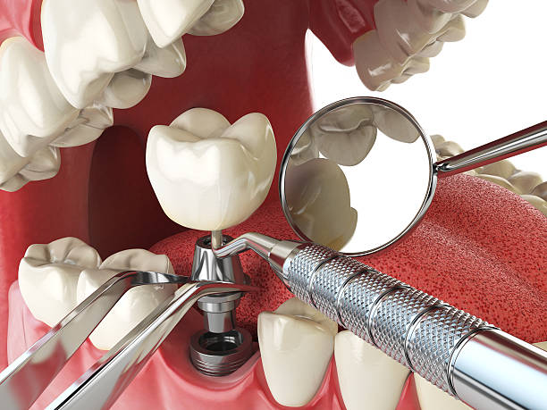 Best Emergency Denture Repair in Clintonville, WI
